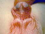 Picture of hypospadias